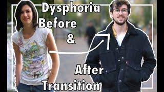 Gender Dysphoria Before & After Transitioning