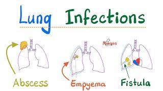 Lung Infections - Lung Abscess, Empyema, Fistula, Aspiration Syndromes, Systemic fungi - Pathology