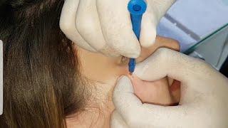 Microdermal Elmacık Kemiği Piercing Delimi