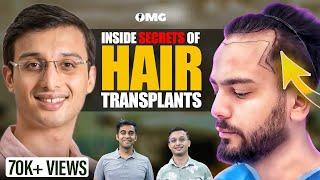 Does Hair Transplant Work for Male Baldness? | Dr. Ankur Sarin | OMG with Divas Gupta