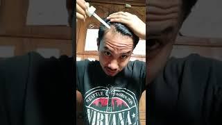 Nyesel Pake Minoxidil 4 bulan!