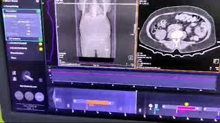 #Aortogram #Ct  scan......... how to do the scan in CT machine.