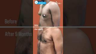 Gynecomastia Grade 3A surgery Result | Male Chest Before After 360° Surgery #shorts