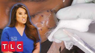 "I'm Pretty Sure I Got It All" Dr. Lee Removes a Massive, Oozing Facial Cyst | Dr. Pimple Popper