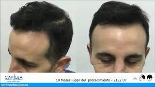 Testimonial Cabello | Capilea México