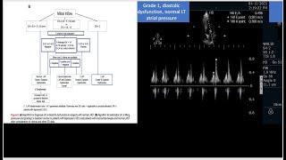 An evidenced based step by step approach to manage a mixed shock  by critical care Echocardiography