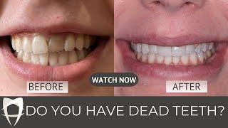 Dead Teeth & How to Save Them | Root Canal Treatment