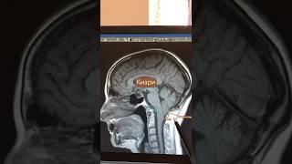 Симптомы и лечение аномалии Киари #аномалияарнольдакиари