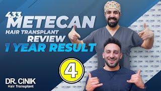 Dr.Cinik Hair Hospital | 433 Metecan 1 Year Result Review