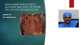 Simpladent single piece multi unit for upper  full mouth rehabilitation