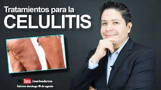 TRATAMIENTOS PARA LA CELULITIS. ¿Como eliminar celulitis? Dr. Marino Dermatologo