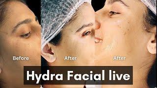 Live Hydra Facial I Step by Step I #hydra #hydrafacial #skincare #skinbrightening