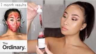 The Ordinary Peeling Solution | 1 Month Use