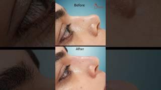 Nose Correction with Filler | Nonsurgical Nose Job | Nose Job Result #shortsfeed
