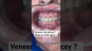 Veneers too pricey? Want to smile again ? Watch this amazing solution 