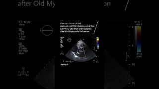 A 69-Year-Old Man with Dyspnea after Old Myocardial Infarction | NEJM