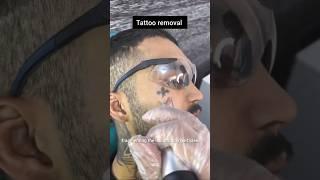 pico laser #tattoremoval #tattoo