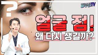 얼굴에 점? 빼도 빼도 다시 생기는 이유는? [피부과전문의 피부심]