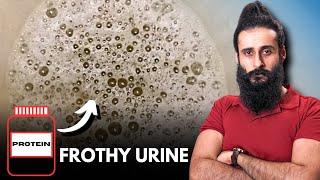 Whey Protein Caused Foamy/Frothy Bubbles In Urine - Proteinuria?