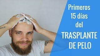 TRASPLANTE DE PELO // ¿QUÉ HACER LOS PRIMEROS DÍAS? ¿QUÉ PUEDES SUFRIR?