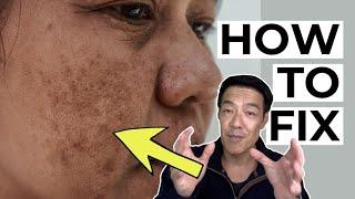 How do Dermatologists FIX Pigmentation? (PIH)