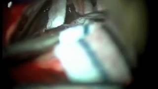 Microvascular Decompression (MVD) Surgery For Trigeminal Ne