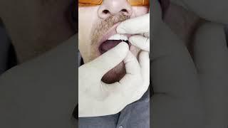Dental implant’s All on 4 in Prague #shorts #dentist #dental #implant #veneers #short
