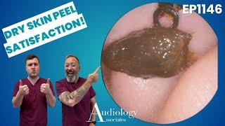 MEGA Ear Wax Removal! Deep Microsuction with Skin Peel | Pediatric & Adult Cases   EP1146