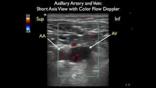 How To: Axillary Vein Cannulation - Sonosite Ultrasound.mp4