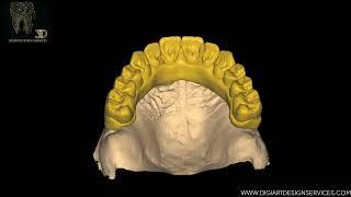 Implant Bridge using Exocad Software at Digiart Design Services