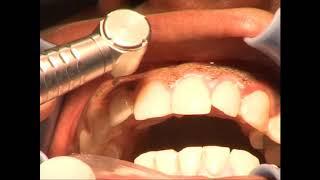 Gum Pigmentation By Diode And Eribum Laser (Dr.Ahmad Abu Aesha)