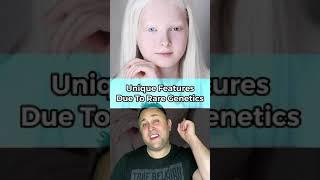 UNIQUE FEATURES DUE TO RARE GENETICS