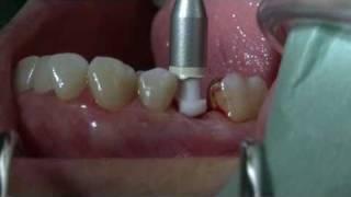 CeraRoot 14  - zirconia dental implant surgery