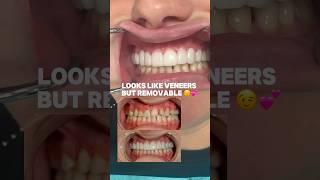 Amazing Removable Veneers ! You think they're veneers but they're not !