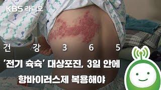 [박광식의 건강365] '전기 슉슉' 대상포진, 3일 안에 항바이러스제 복용해야