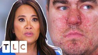Dr Lee Treats Autistic Man For Skin Condition Common In People With Special Needs | Dr Pimple Popper