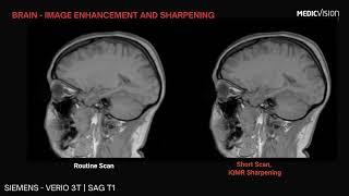 iQMR MRI Image enhancement: Brain scan, Siemens SAG T1 POST