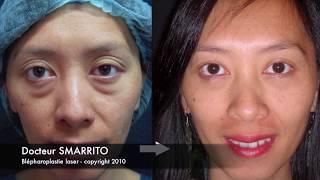 Laser Blepharoplasty Dr SMARRITO - Chirurgie des paupières au laser.