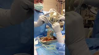 Breast Enhancement Surgery #shorts #breastimplant