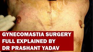 Man Boobs Surgery !! Cost of Gynecomastia Surgery !! Dr. Prashant Yadav