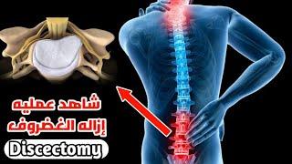 شاهد عمليه إزاله غضروف الظهر بأبسط أسلوب_lumbar discectomy