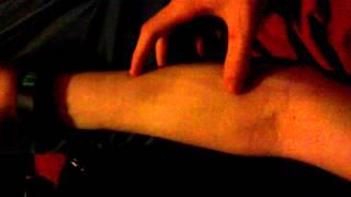 Vein Popper