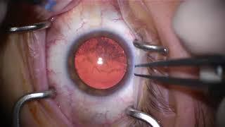 My Cataract Surgery