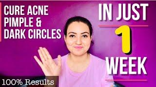 Acne Treatment : All You Need To Know About Acne And Pimple | Best Home Remedy for Acne & Pimple 