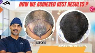 Hair Transplant In Dubai | Best Clinic Surgeon Cost & Results Of Hair Transplant In Dubai