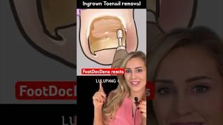 Doctor reacts: ingrown nail asmr