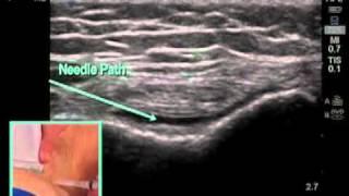 How to: Ultrasound Guided Knee Injection Scanning Technique