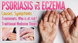 Psoriasis vs eczema causes, symptoms, treatment, traditional medicine theory comparison