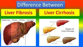 Difference Between   Liver Fibrosis And Liver Cirrhosis