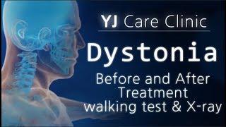 Dystonia patients / Before and after treatment / walking test / x-ray / 사경증환자 치료전후 비교 / 근긴장이상증